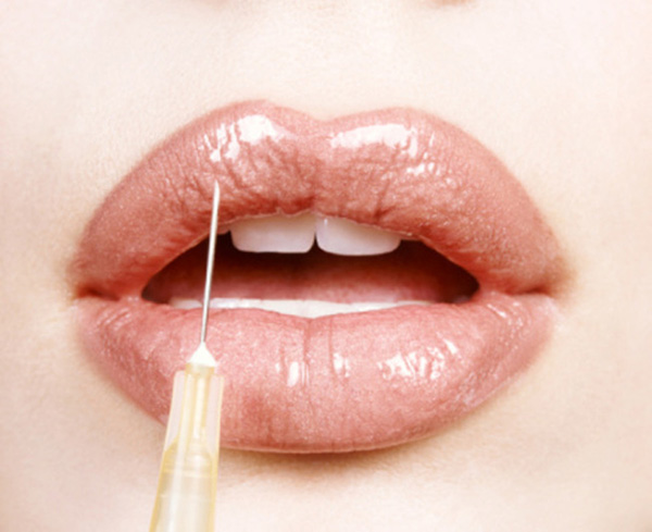 Close-up of a Woman's Lips Receiving Cosmetic Surgery from a Syringe