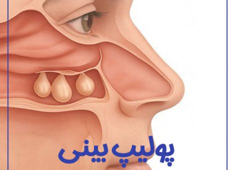 Nasal-polyp