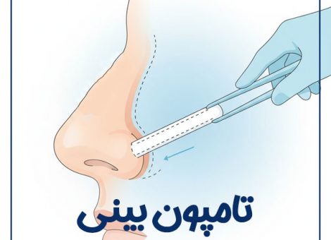 nasal-tampon-2