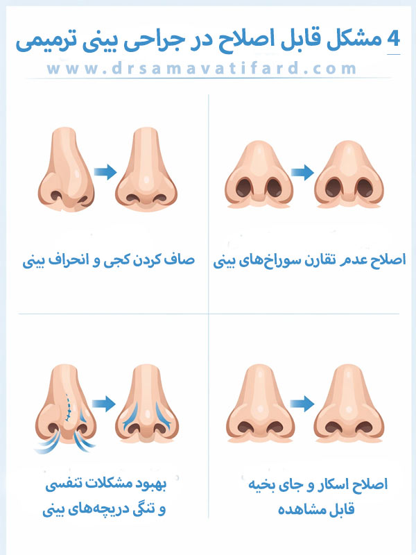 revision-rhinoplasty-3
