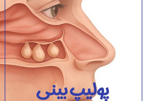 Nasal-polyp