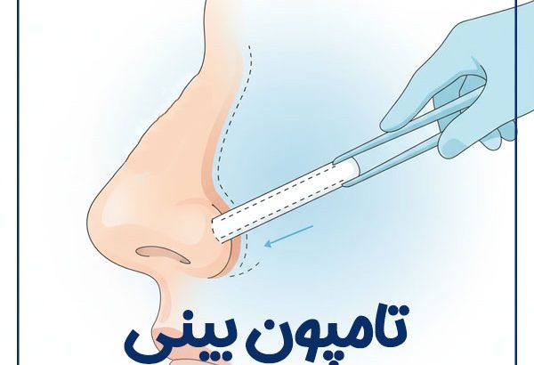 nasal-tampon-2
